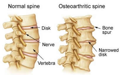subluxation degeneration